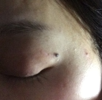 文文|6岁女孩患上“皮肤癌”,医生检查出诱因,很多家长还在犯