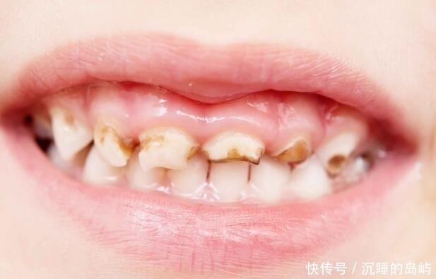 家长要留心观察，孩子牙齿有4种现象，要及早治疗，别忽视