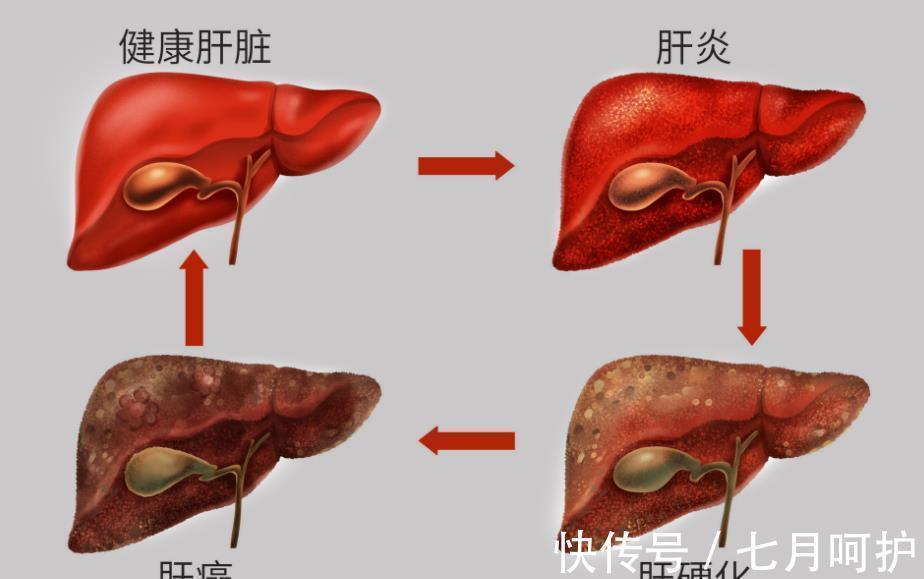 肝功能|肝不好的人，不能吃羊肉吗？医生：不止羊肉，这3种肉尽可能不吃