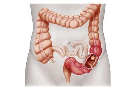 治疗|大肠癌一发现就是晚期，医生忠告，身体的两种小病最好及时治疗