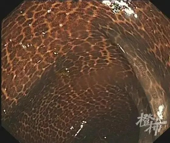 黏膜|吓人!一女子的肠子表面像蛇皮,竟因长期吃这东西!很多人用它来治便秘