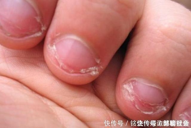 专家|从小“咬指甲”的孩子,长大后怎么样了专家逃不掉2种结局