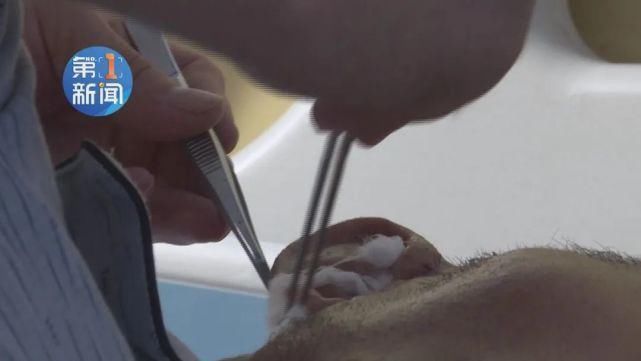 医院|老张从树上坠下,醒来后发现耳朵在自己手里