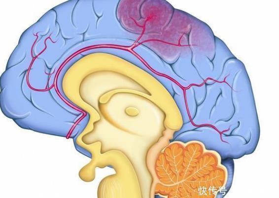 脑出血|脑溢血并不是突如其来,6个症状反复出现,就是事先已通知你了!