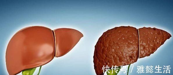 肝硬化患者|肝硬化患者，身体如果没有3个“症状”，恭喜，证明肝脏在好转