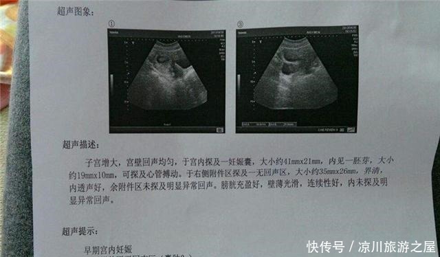 薇薇|看懂孕期第一张B超单很重要，了解孕囊、胎芽、胎心的形成规律