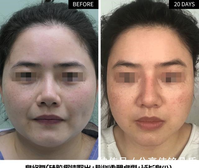 硅胶 硅胶隆鼻——挛缩、朝天是致命伤,要怎么修复看她20天术后变化!