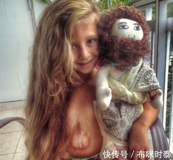 五联症|6岁小女孩患罕见怪病,心脏长在身体外,用微笑感动无数人