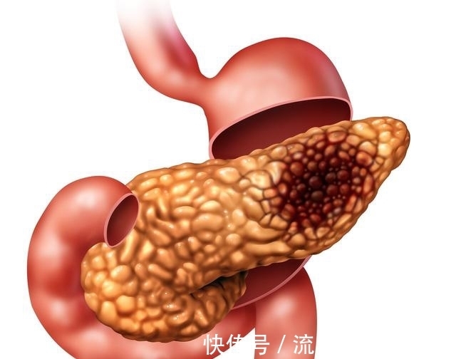 胰腺癌|胰腺癌俗称癌王,如何早期诊断,医生总结这六点,早发现活得长