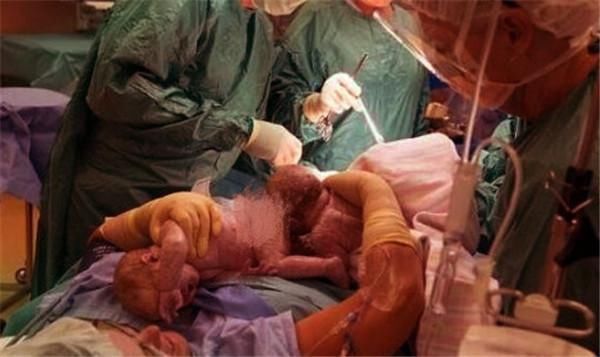 孕妇|孕妇怀孕8个月摔倒大出血，胎儿没有生命体征，剖腹却有意外收获