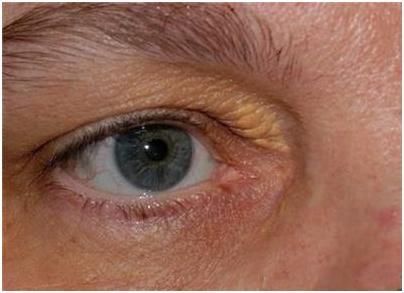 血管的清洁工不是山楂而是它,若坚持吃,高血脂退避三舍