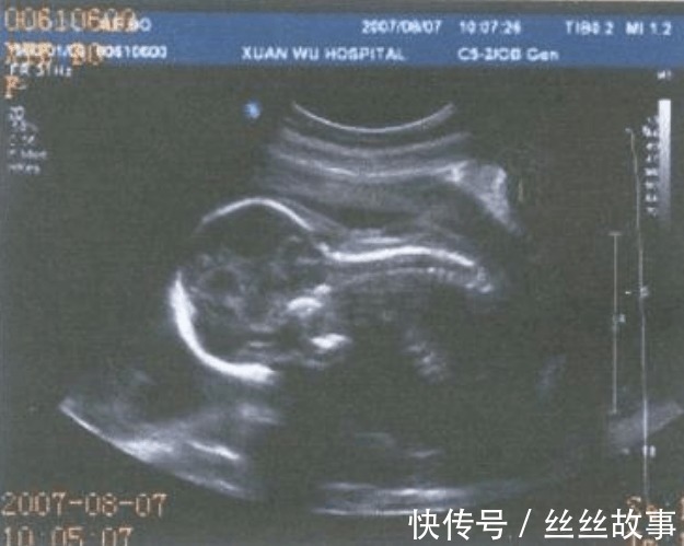 b超单|B超单上的这4个字是什么意思 别担心, 别人羡慕还来不及呢
