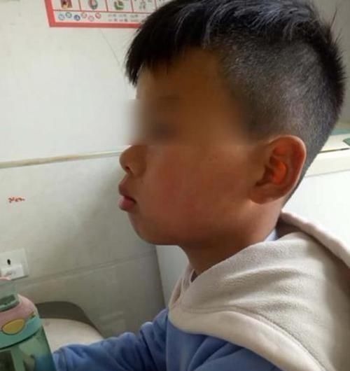 妈妈|儿子越长越像“大猩猩”,妈妈带去检查后,医生责问咋不早点来