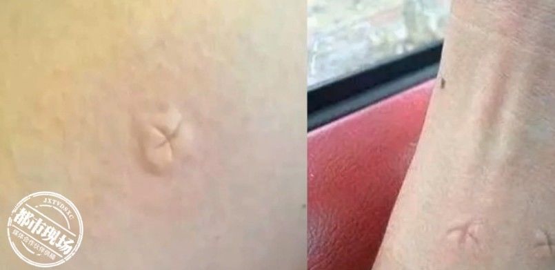 叮咬|孩子被蚊子叮咬后,千万别这么做,医生:小心加重感染