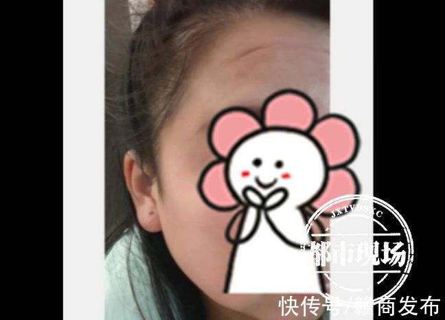 红谷滩区 女子在南昌“柠美”做手术能旺夫？术后财运没起色 额头多了坑