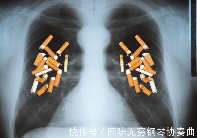 恶性肿瘤|肺癌早期如何筛查?哪些人需要每年做胸部CT检查?医生告诉你答案