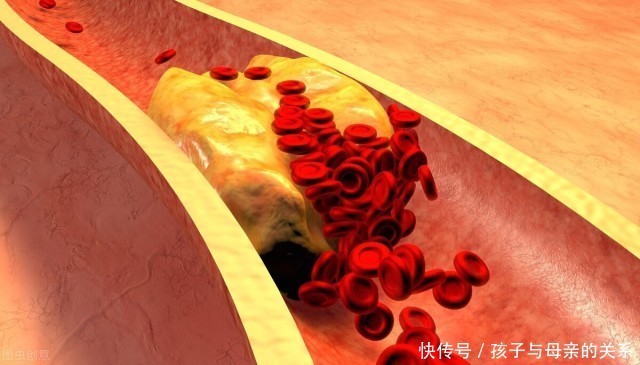 大叔甘油三|甘油三酯从6.8降到1.5,57岁大叔所用的方法,连医生都说好