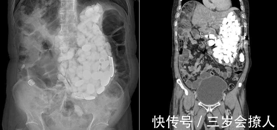 医院|男子腹痛送医院,医生取出2公斤“垃圾”,男子回答:焦虑时爱吃