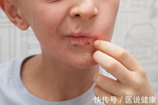 肝胆火旺|早上起床经常出现口干口苦现象时,注意可能和3个因素有关