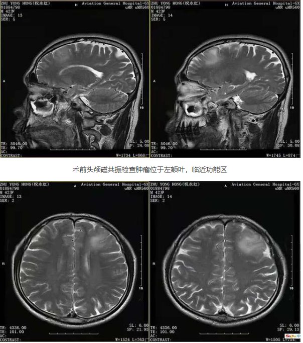 手术治疗|机器人辅助定位助力颅内胶质瘤精准切除