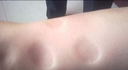 生理性|孕期“生理性水肿”和“病理性水肿”的区分，以及缓解水肿方法！