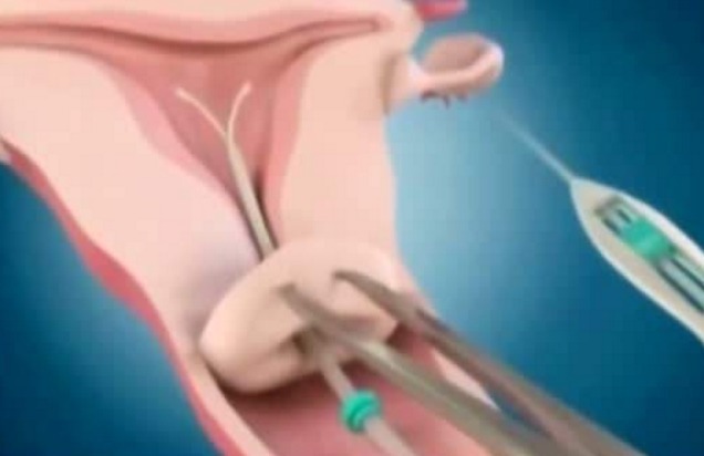 腰酸背痛|当年很火的“上环”,如今为何销声匿迹别再让爱人“上环”