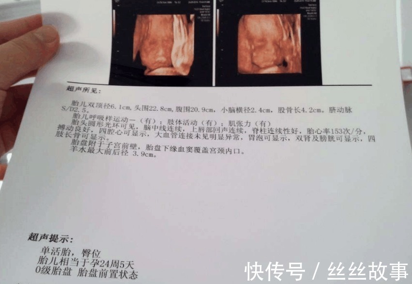 b超单|B超单上的这4个字是什么意思 别担心, 别人羡慕还来不及呢