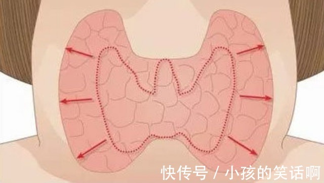 辛辣刺激|甲状腺有结节?饮食不能太放肆,牢记“2吃2不吃”或有助结节消散