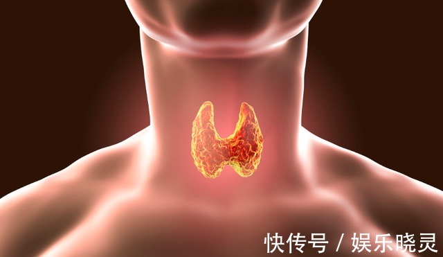 饮食习惯|一家四口先后查出甲状腺癌,“诱因”也许是这些菜,不妨了解一下