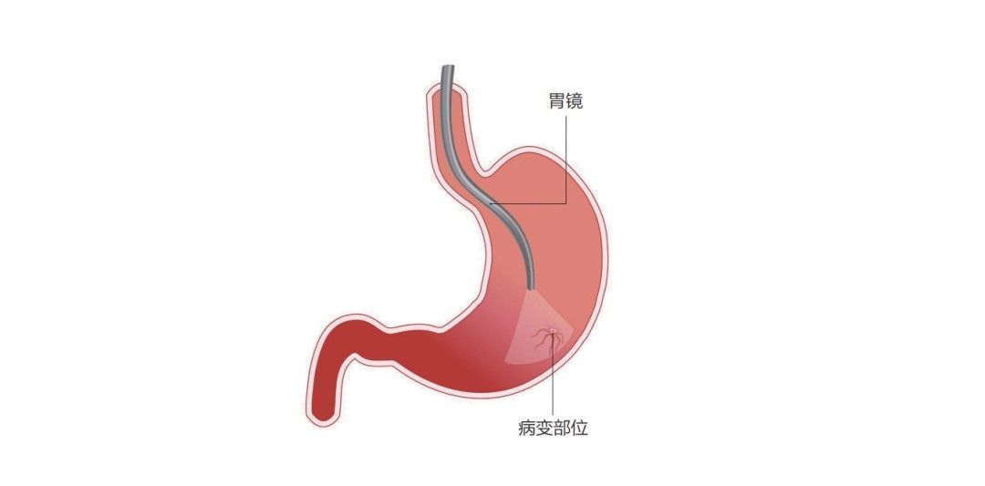 为什么要做胃镜？胃镜有何神奇之处？|体检季 | 胃镜检查