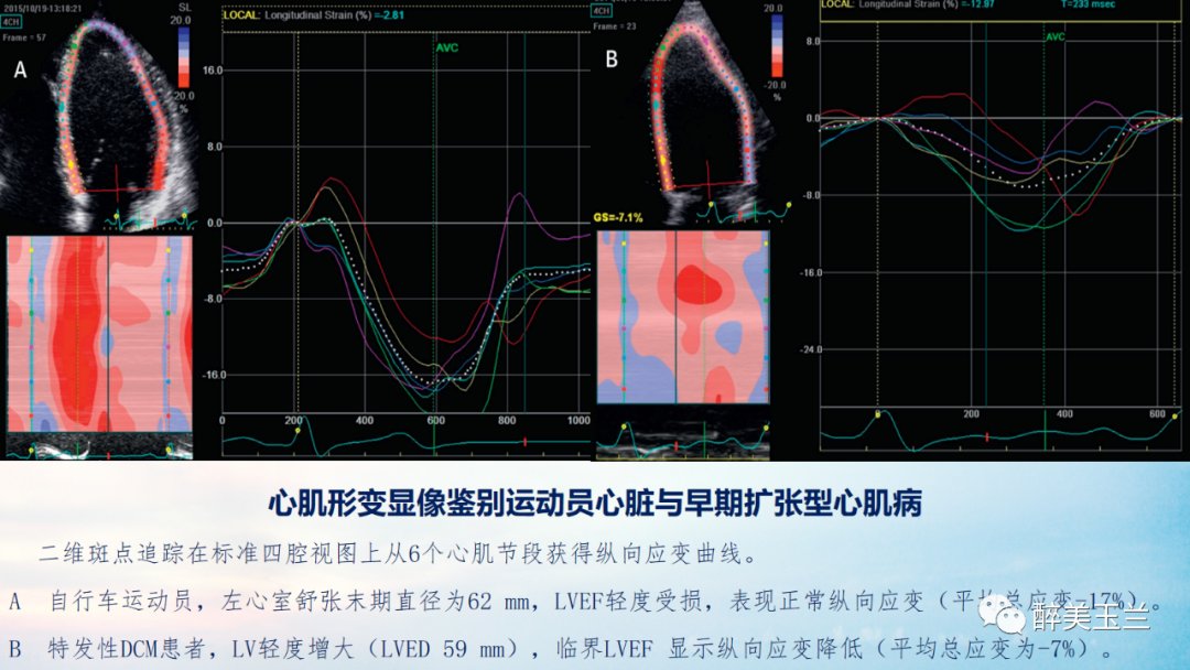 扩张型心肌病患者非心脏手术的全身麻醉一例|病例讨论 | 全身麻醉