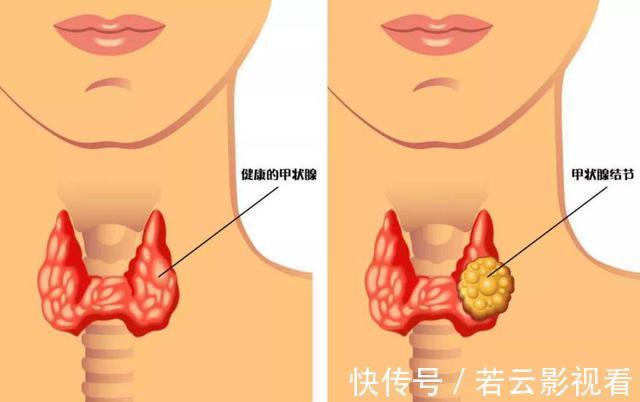 单发|什么是甲状腺结节?饮食上需要注意什么?