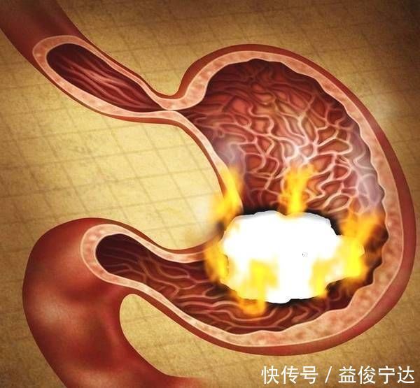 胃溃疡|幽门螺杆菌吃药3年不如用它烧成汤吃7天,杀菌养胃消除胃病胀痛