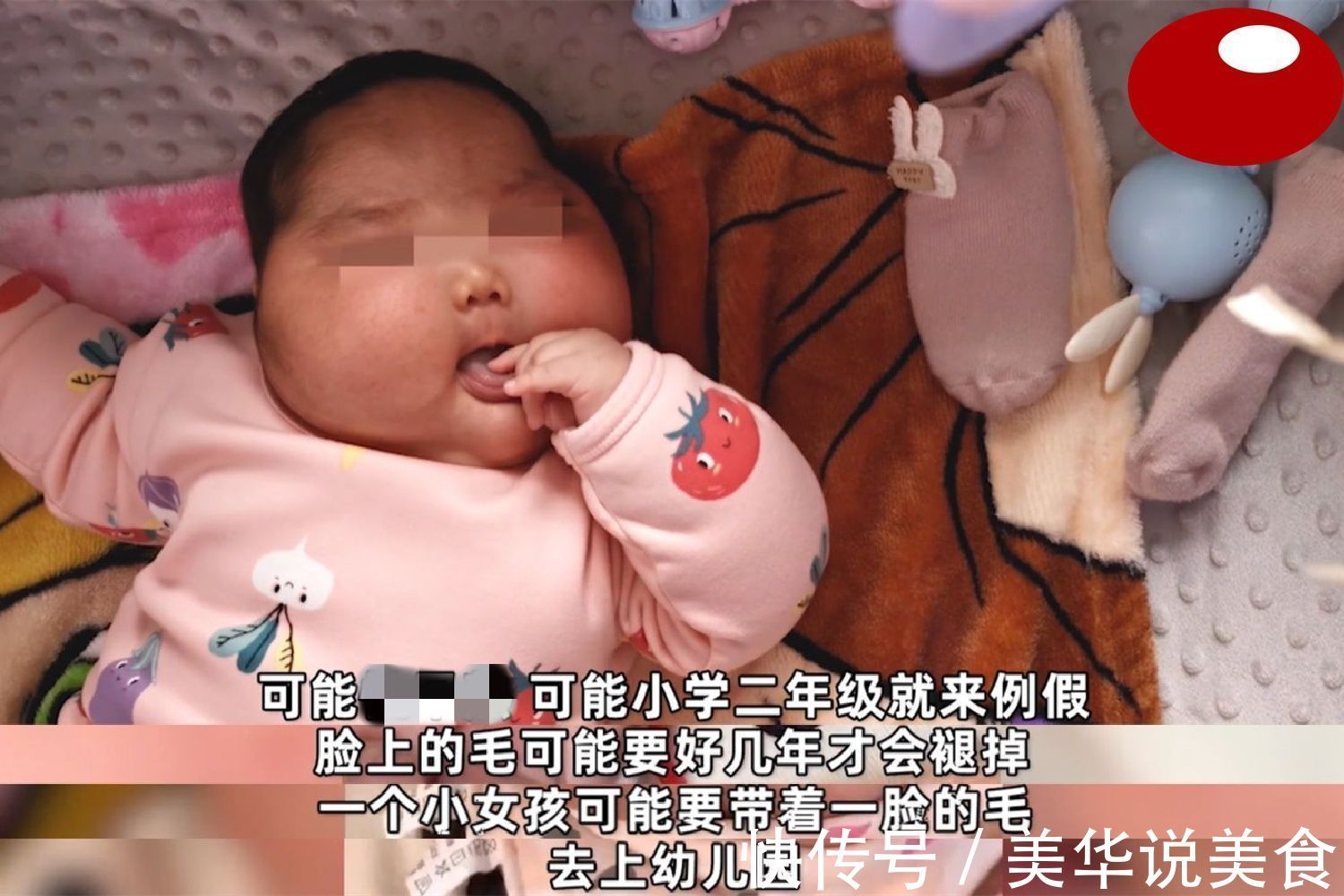 大头娃娃|“大头娃娃”再现,抑菌霜激素超标,致5个月女婴疯狂长胖长毛