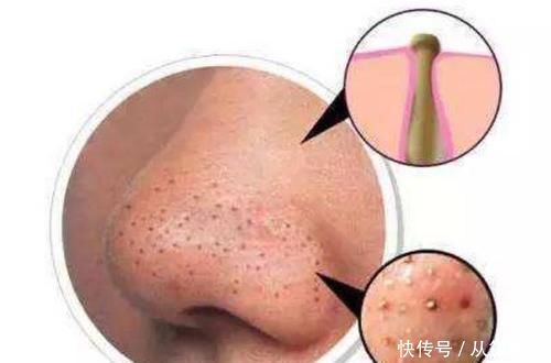 鼻尖挤出“白色条状物”？学会3招，趁早和“草莓鼻”说再见