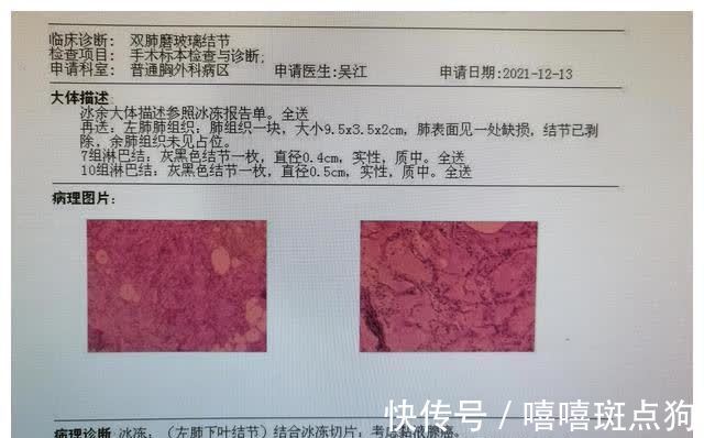 结节|磨玻璃肺癌都是高分化腺癌吗？磨玻璃结节发展到哪种腺癌都有可能