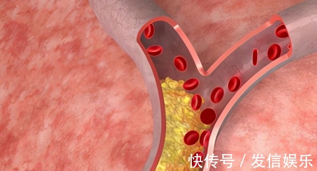 胆固醇|为什么脑梗死越来越多？哈佛大学医学院：这8件事坚持做可预防！