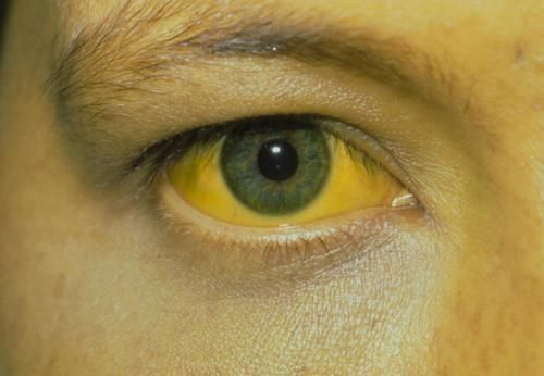 张大哥|43岁男子滴酒不沾，确诊肝癌，化疗4次离世，医生：这2物怎能常吃