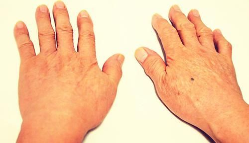  早期|肺癌来临，早期没有征兆？医生：身体有处莫名“长厚”，提高警惕