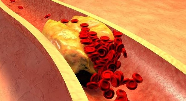 升高|血脂升高,身体2处会有变化,坚持3个习惯,让血脂慢慢降下来