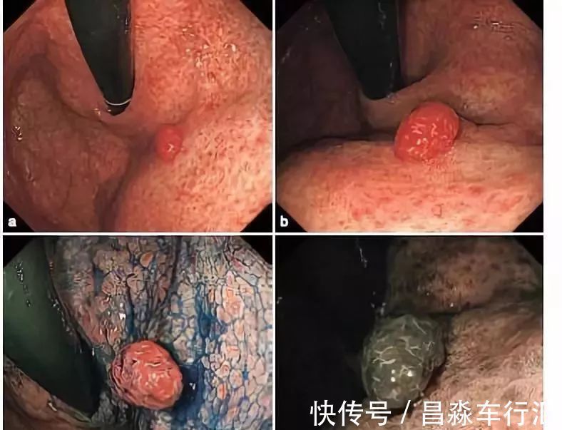 癌变|大家好!我叫“息肉”,癌症的近亲!我最怕无情又温柔的手术刀:艾灸