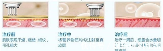 补水 水光针术后需要注意什么!