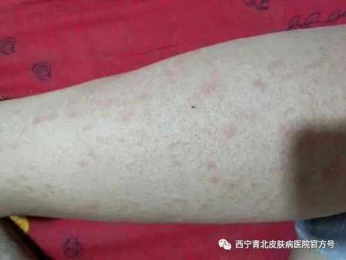 西宁治皮肤病哪家好