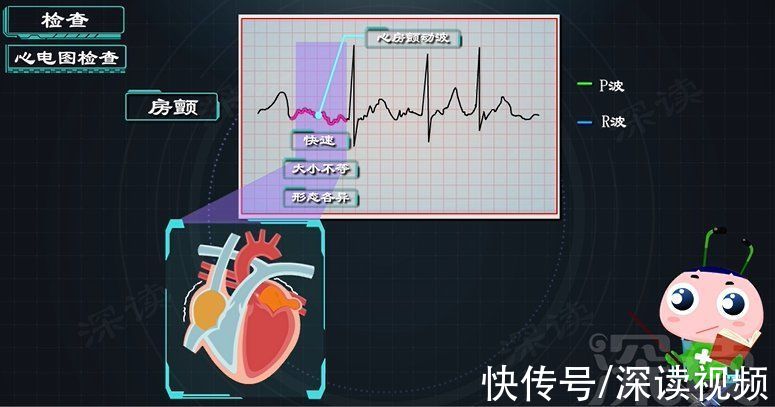 心房|久坐房颤发生率高5倍？酗酒肥胖更易得房颤？房颤发病因素知多少