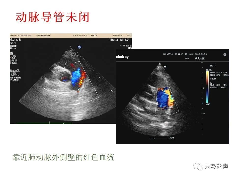 超声|肺动脉瓣周边异常血流的超声鉴别
