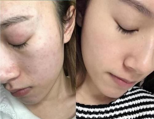 洁面|刚打湿脸就急着抹洗面奶，难怪黑头闭口疯长，教你正确的洗脸方式