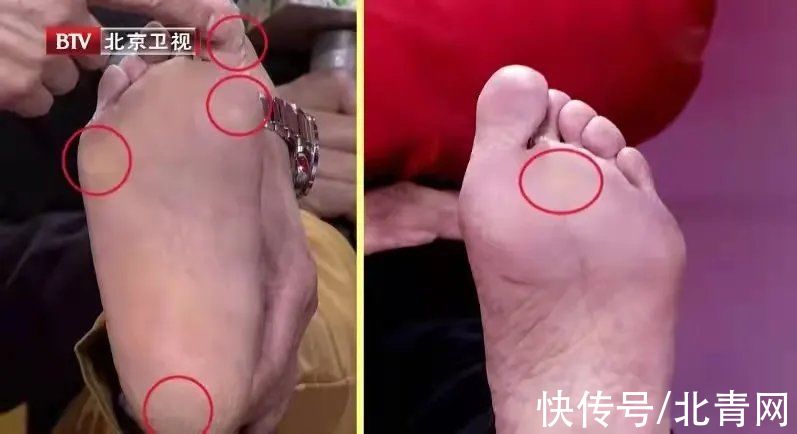 杀菌|一人得脚气，全家都遭殃