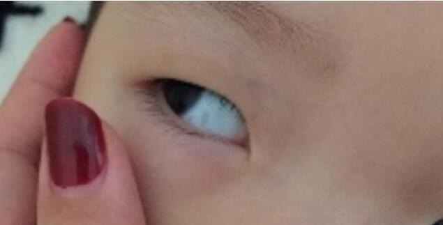 眼白|3岁宝宝眼白出现黑点,怎么回事儿听了医生的答案,终于放心了