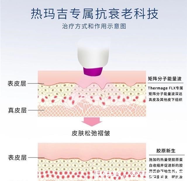 胶原蛋白 盘点热玛吉容易踩的坑!