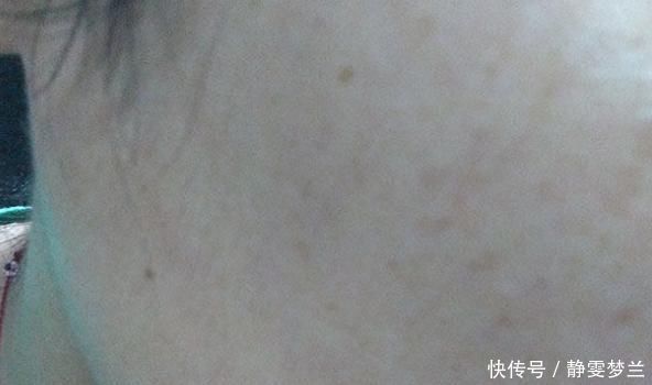 凝血功能|肝病大多是“拖”出来的,皮肤出现3种改变,多半是肝在“求救”